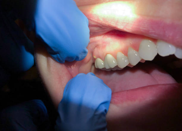 Emergency Dental Filling Replacement in NE